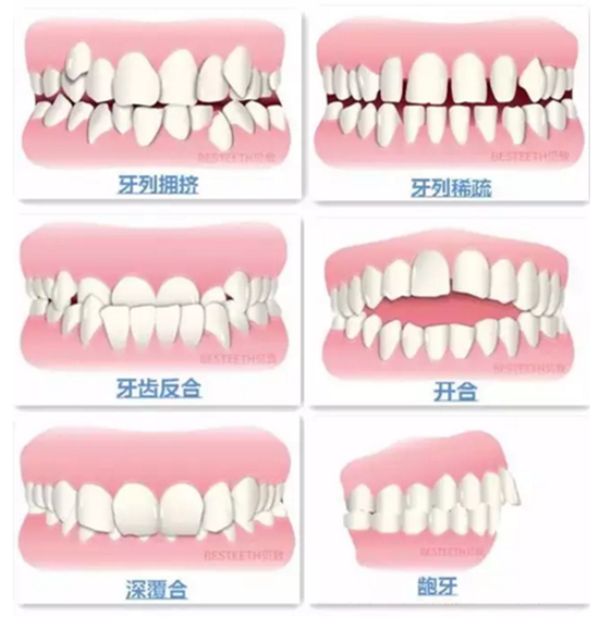 【口腔科普】關(guān)于矯牙前、中、后需要注意的問題，了解一下？