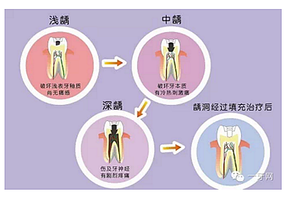 詳解牙疼的原因分幾種？