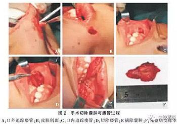 面頰部皮樣囊腫伴皮瘺1例報(bào)道