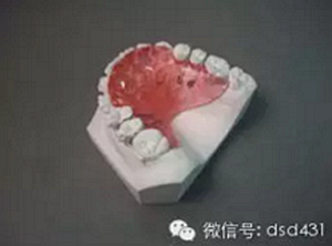 是什么導(dǎo)致了義齒返工？？？