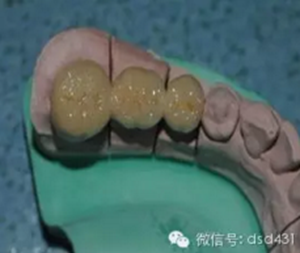 是什么導(dǎo)致了義齒返工？？？