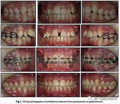 正畸文獻閱讀--正畸過程中牙根移動的三維監(jiān)測