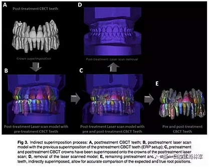 正畸文獻閱讀--正畸過程中牙根移動的三維監(jiān)測