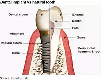 種植體，在全球牙科設備市場的變化！
