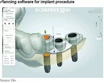 種植體，在全球牙科設備市場的變化！
