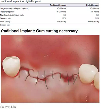 種植體，在全球牙科設備市場的變化！