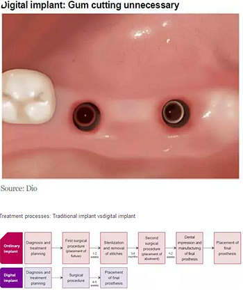 種植體，在全球牙科設備市場的變化！