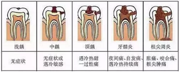 牙齒從針眼大的洞到拔除，步步驚心！