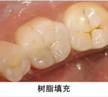 完全不懂，各種補牙材料，到底怎么選？