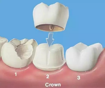 完全不懂，各種補牙材料，到底怎么選？