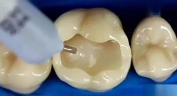 完全不懂，各種補牙材料，到底怎么選？