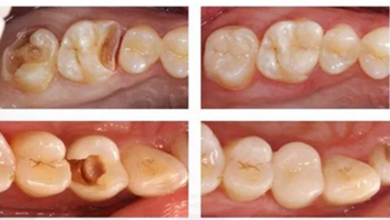 完全不懂，各種補牙材料，到底怎么選？