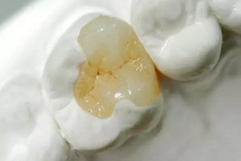 完全不懂，各種補牙材料，到底怎么選？