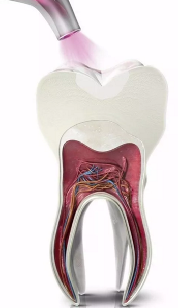 完全不懂，各種補牙材料，到底怎么選？