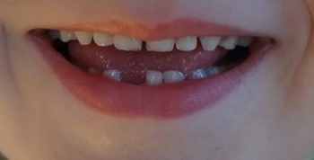 涂氟還是窩溝封閉？到底該給孩子做哪個？