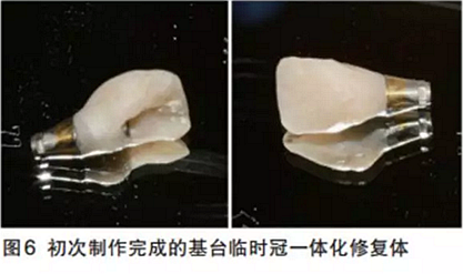 前牙即刻種植并個性化基臺美學(xué)修復(fù)