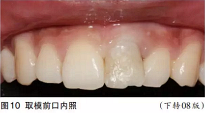 前牙即刻種植并個性化基臺美學(xué)修復(fù)