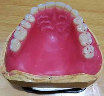 口腔患者的福音，卓逸精品工作室吸附性義齒案例鑒賞