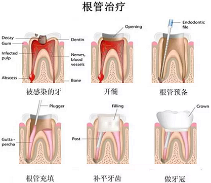 【科普】牙齒根管治療大全