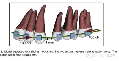 正畸文獻閱讀--對于滑動法關(guān)閉間隙的有限元分析