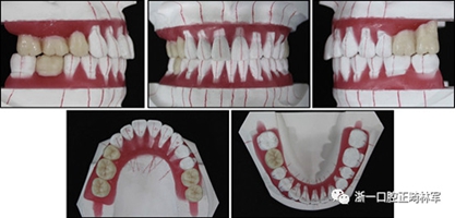 文獻優(yōu)秀正畸病例賞析--多顆牙齒缺失的牙周炎患者的跨學(xué)科綜合治療