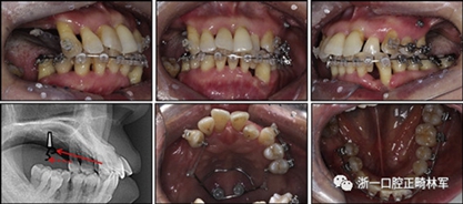 文獻優(yōu)秀正畸病例賞析--多顆牙齒缺失的牙周炎患者的跨學(xué)科綜合治療