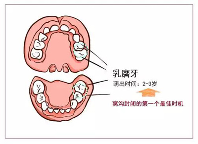 窩溝封閉丨孩子牙齒的“鎧甲勇士”