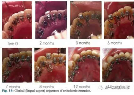 文獻(xiàn)優(yōu)秀正畸病例賞析--正畸牙周聯(lián)合治療方法病例介紹
