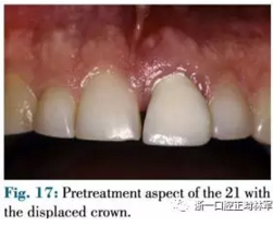 文獻(xiàn)優(yōu)秀正畸病例賞析--正畸牙周聯(lián)合治療方法病例介紹