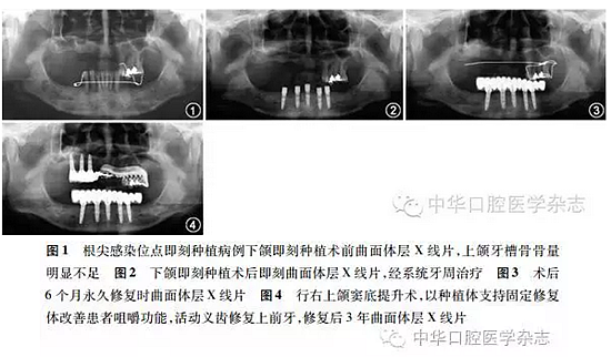 【專家筆談】即刻種植治療方案的評(píng)估與實(shí)施