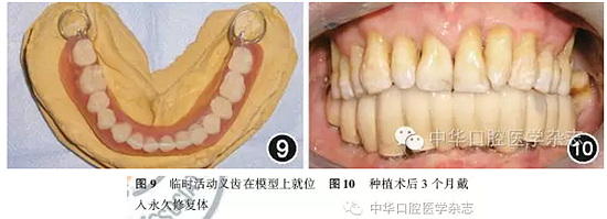 【專家筆談】即刻種植治療方案的評(píng)估與實(shí)施