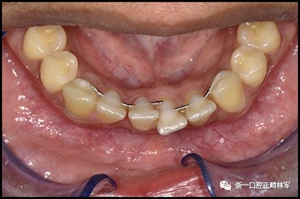 正畸文獻(xiàn)閱讀--固定舌側(cè)保持器作用下意外的牙齒移動