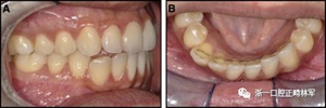 正畸文獻(xiàn)閱讀--固定舌側(cè)保持器作用下意外的牙齒移動