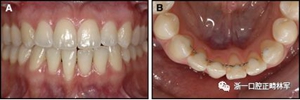 正畸文獻(xiàn)閱讀--固定舌側(cè)保持器作用下意外的牙齒移動