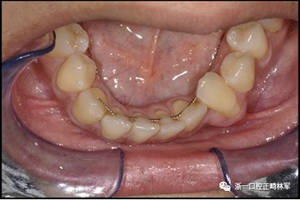 正畸文獻(xiàn)閱讀--固定舌側(cè)保持器作用下意外的牙齒移動