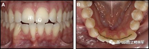 正畸文獻(xiàn)閱讀--固定舌側(cè)保持器作用下意外的牙齒移動