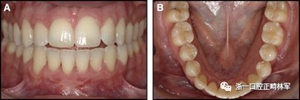 正畸文獻(xiàn)閱讀--固定舌側(cè)保持器作用下意外的牙齒移動