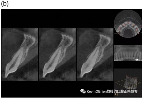 【同步新文】正畸牙根吸收是個(gè)問題嗎？一項(xiàng)新的系統(tǒng)評(píng)價(jià)