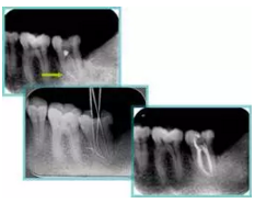 知識(shí)分享：根管治療的標(biāo)準(zhǔn)步驟