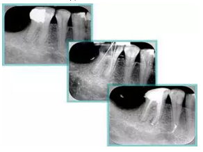 知識分享：根管治療的標(biāo)準(zhǔn)步驟