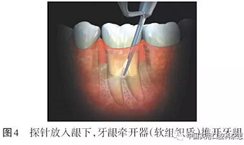 專題筆談 | 內(nèi)窺鏡在牙周診療中的應(yīng)用進(jìn)展