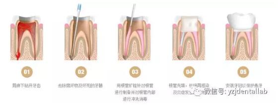 根管治療 根管治療