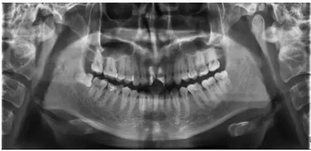 根管治療 根管治療