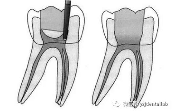 根管治療 根管治療