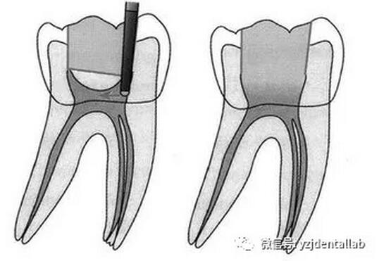根管治療 根管治療