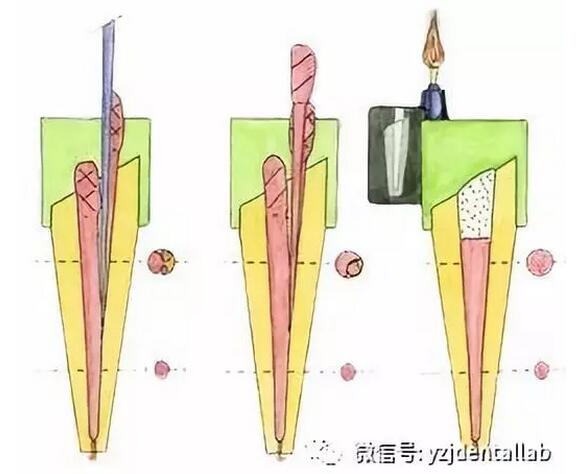 根管治療 根管治療