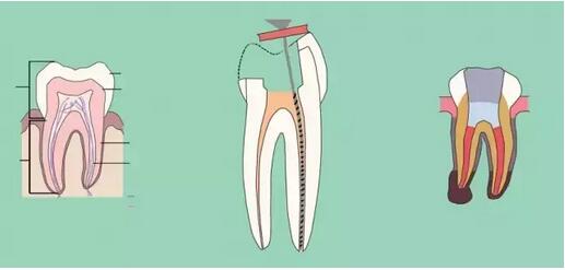 根管治療 根管治療