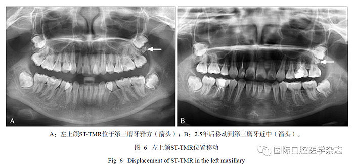 46例患者第三磨牙區(qū)多生牙的影像學分析 46例患者第三磨牙區(qū)多生牙的影像學分析