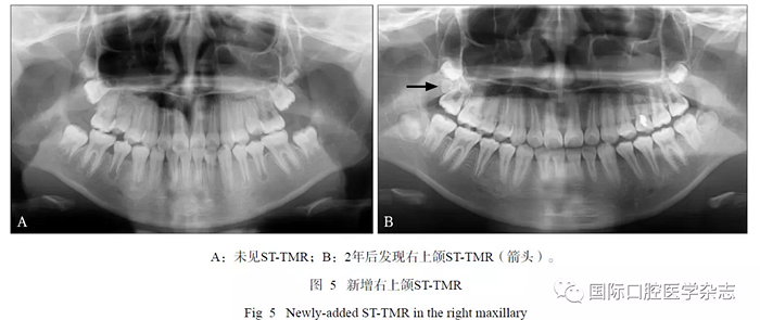 46例患者第三磨牙區(qū)多生牙的影像學分析 46例患者第三磨牙區(qū)多生牙的影像學分析