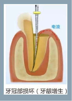 多頻技術(shù)的根管長(zhǎng)度測(cè)定儀